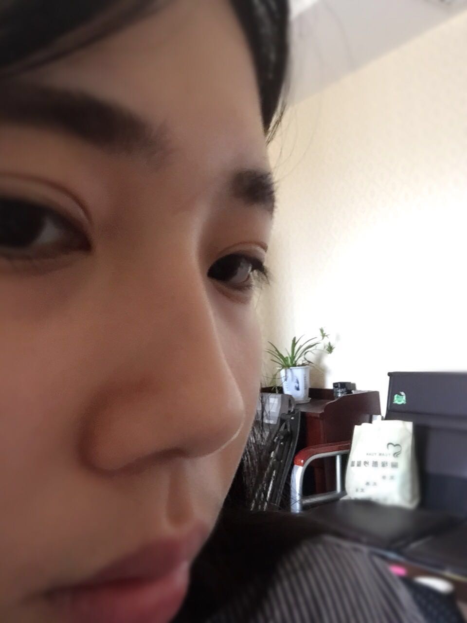 做完鼻骨縮窄手術(shù)一個多月的樣子