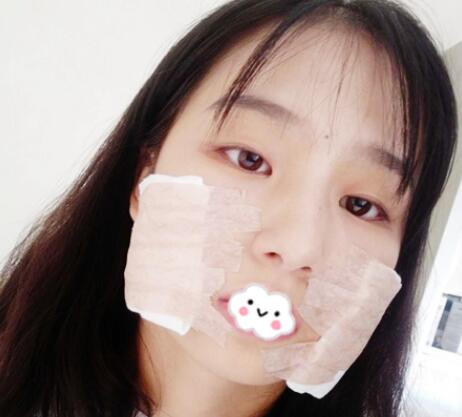 下頜角案例手術