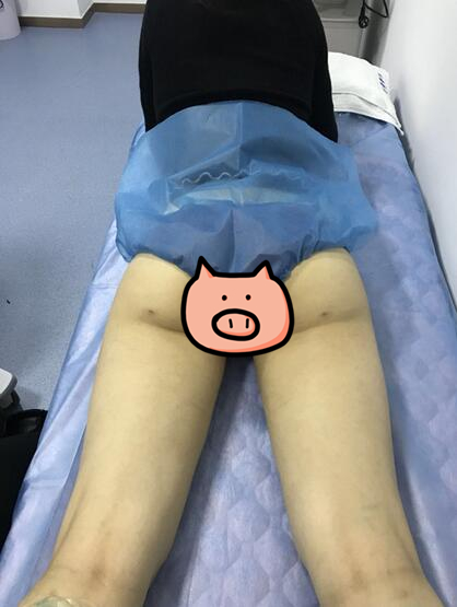 鄭州至美整形專家劉永生做大腿吸脂怎么樣？劉永生做大腿吸脂案例效果