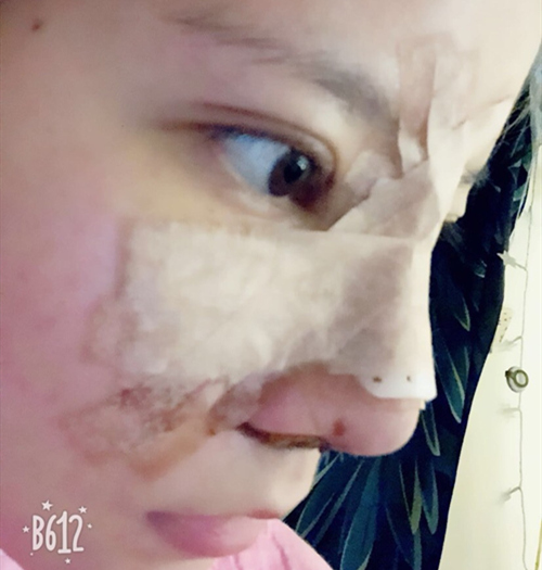 王良發(fā)假體隆鼻案例效果對(duì)比圖