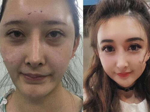 面部脂肪填充，整個(gè)人都發(fā)生了很大變化。