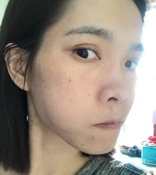 北京藝星整形專家廖苑利做光子嫩膚怎么樣？廖苑利光子嫩膚案例效果展示