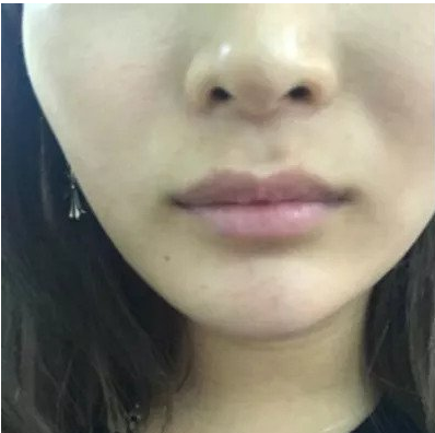 岳陽春天整形專家蔣正華做玻尿酸豐唇怎么樣?蔣正華玻尿酸豐唇案例分享