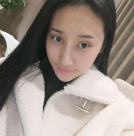北京葉子整形美容醫(yī)院做焊接雙眼皮效果怎么樣？北京葉子整形焊接雙眼皮案例展示