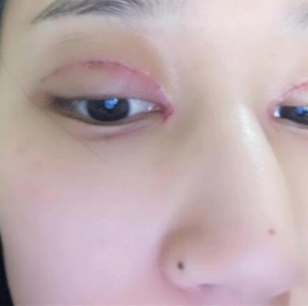 北京葉子整形美容醫(yī)院做焊接雙眼皮效果怎么樣？北京葉子整形焊接雙眼皮案例展示