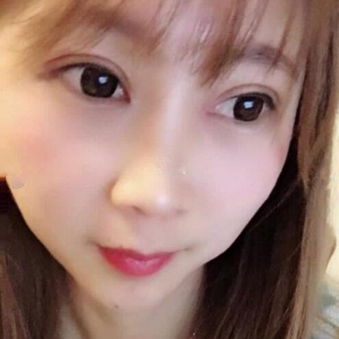 淄博美聯(lián)臣醫(yī)療美容醫(yī)院做切開雙眼皮怎么樣？切開雙眼皮案例分享