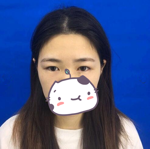 西昌玥美整形專家湯穎峰做雙眼皮怎么樣？湯穎峰雙眼皮案例賞析