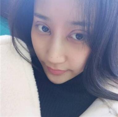 北京葉子整形焊接雙眼皮案例展示