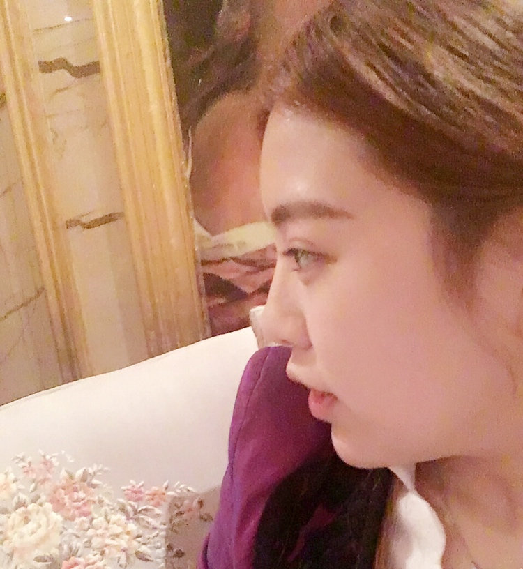 黑龍江藝星醫(yī)生巫文云做鼻部修復(fù)怎么樣，巫文云玻鼻部修復(fù)案例分享