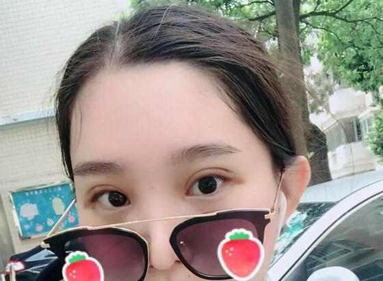 鄭州蕾娜斯彭沖醫(yī)生做微創(chuàng)雙眼皮效果怎么樣？微創(chuàng)雙眼皮案例效果展示