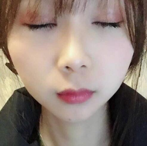 福州久植因美整形醫(yī)生張曉棠眼綜合整形案例分享
