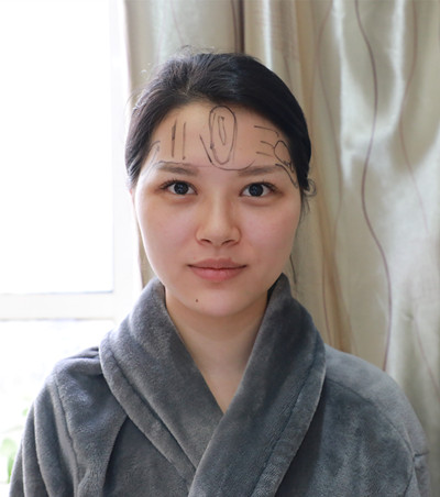 昆明醫(yī)科大學(xué)第一附屬醫(yī)院整形外科做臉部脂肪填充效果怎么樣？