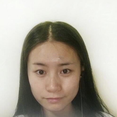 長春銘妍醫(yī)療美容門診部做雙眼皮怎么樣？長春銘妍雙眼皮案例分享