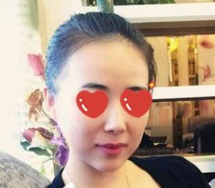 上海美萊醫(yī)生熊師做玻尿酸隆下巴怎么樣，熊師玻尿酸隆下巴案例分享