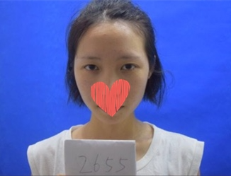 北京美萊整形專家杜園園開外眼角怎么樣？杜園園開外眼角案例效果對(duì)比圖