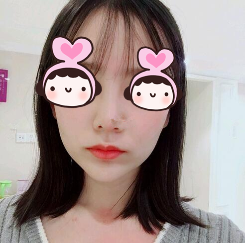 廈門海峽整形專家王翼耕做隆鼻的心得體會(huì)，王翼耕做隆鼻效果怎么樣？