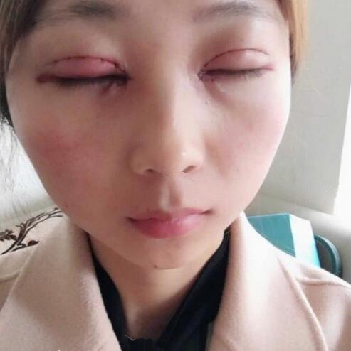 淄博美聯(lián)臣醫(yī)療美容醫(yī)院做切開雙眼皮怎么樣？切開雙眼皮案例分享