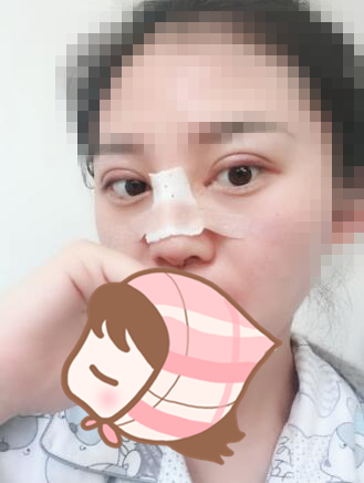 術(shù)后60天效果。