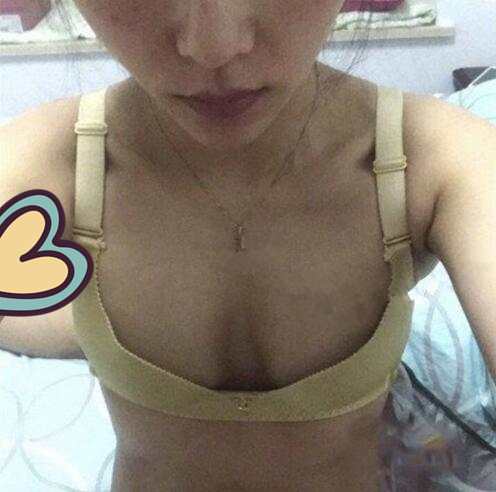 廣州駐顏光醫(yī)療美容診所整形專家劉培做復(fù)合隆胸技術(shù)怎么樣？附案例