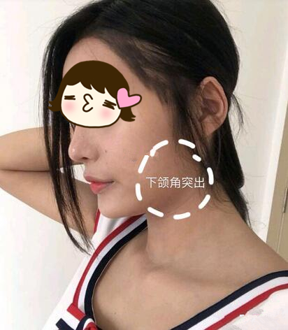 滄州瑞美醫(yī)療整形專(zhuān)家張鵬做下頜角磨骨整形技術(shù)怎么樣？附案例