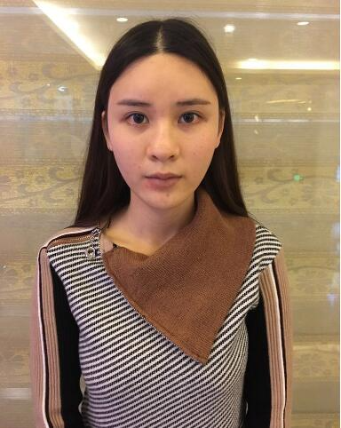 北京藝星整形專家郭峰做假體隆鼻修復(fù)怎么樣？郭峰假體隆鼻修復(fù)案例