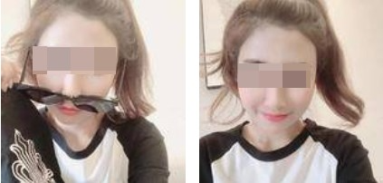 昆明麗都整形醫(yī)生孟春麗做面部自體脂肪填充效果怎么樣？