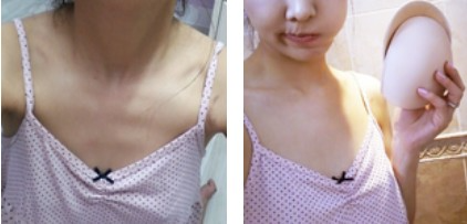 沈陽杏林整形美容醫(yī)院崔昌墉醫(yī)生做假體隆胸技術(shù)怎么樣？附案例