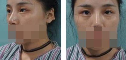 寧波美仁整形美容醫(yī)院李英大醫(yī)生做切開雙眼皮效果怎么樣？