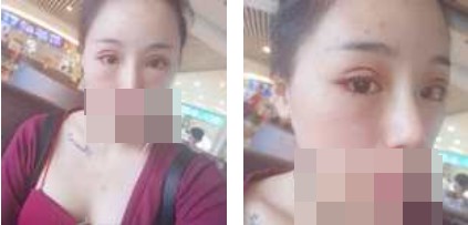 寧波美仁整形美容醫(yī)院李英大醫(yī)生做切開雙眼皮效果怎么樣？