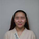 深圳尚虹醫(yī)療整形醫(yī)生藍(lán)劍雄做自體脂肪豐面頰效果怎么樣？附案例