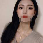 蘇州愛思特醫(yī)療美容醫(yī)院翟奔宇醫(yī)生肋軟骨隆鼻案例效果對(duì)比圖