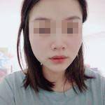 濟南曹博士美容整形醫(yī)院做玻尿酸豐面頰怎么樣？陳正喜醫(yī)生案例