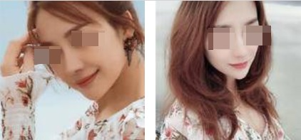 上海攸維醫(yī)療美容診所整形醫(yī)生李靜做膨體隆鼻效果怎么樣？附案例展示