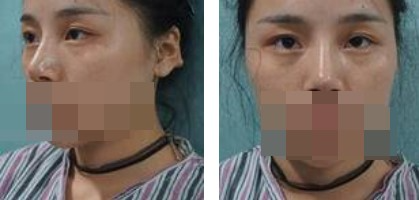 寧波美仁整形美容醫(yī)院李英大醫(yī)生做切開雙眼皮效果怎么樣？