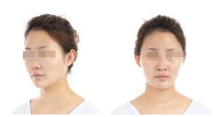 蘭州美月整形美容醫(yī)院文輝才醫(yī)生做鼻綜合整形效果怎么樣？附鼻綜合案例