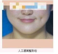 德州市第二人民醫(yī)院燒傷美容整形科張波濤醫(yī)生做酒窩成形術(shù)怎么樣？