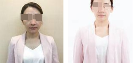 上海攸維醫(yī)療美容診所整形醫(yī)生李靜做膨體隆鼻效果怎么樣？附案例展示