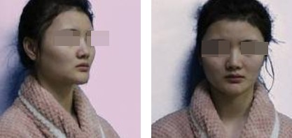 上海新健威醫(yī)療整形醫(yī)生錢(qián)成寶做肋軟骨隆鼻+自體脂肪全臉填充案例