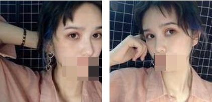 做了切開雙眼皮手術(shù)，才發(fā)現(xiàn)自己原來可以這么美！