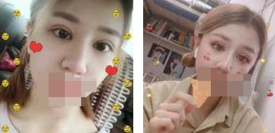 做了全切雙眼皮不僅外表變美了，內心也更加自信了