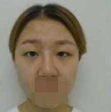 做了全切雙眼皮不僅外表變美了，內心也更加自信了