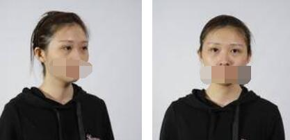沒(méi)有了眼袋困擾，身體和心態(tài)都年輕了十歲
