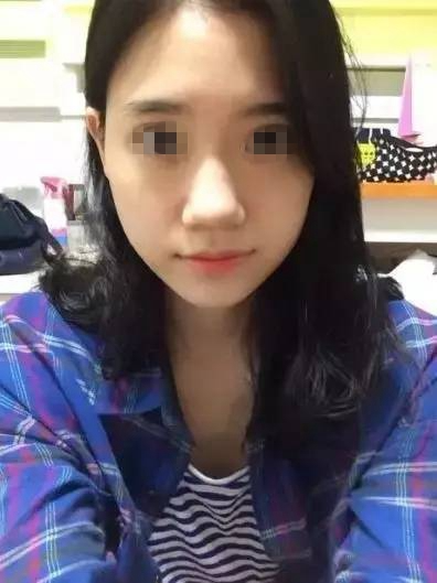 做完膨體隆鼻，鼻子變“挺”了