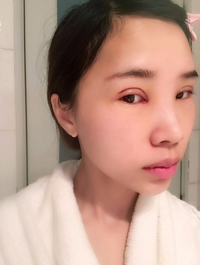 合肥艾雅整形美容醫(yī)院醫(yī)生楊海平做雙眼皮手術(shù)怎么樣？楊海平雙眼皮手術(shù)案例