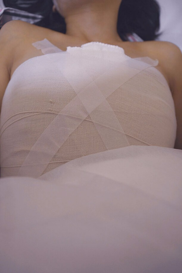 邯鄲凱潤婷整形醫(yī)生馬戰(zhàn)勝做自體脂肪隆胸怎么樣？ 附馬戰(zhàn)勝自體脂肪隆胸案例
