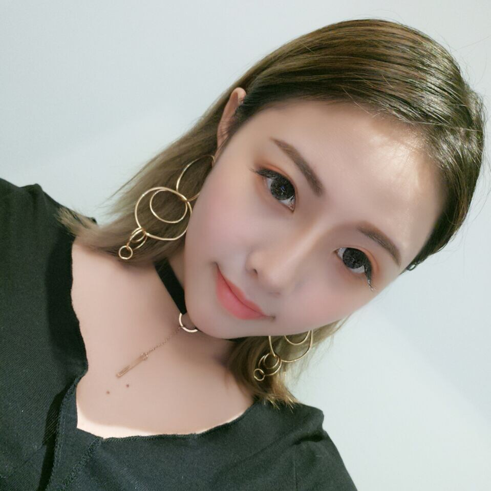 整形醫(yī)生徐長亮做切開雙眼皮案例效果對(duì)比圖