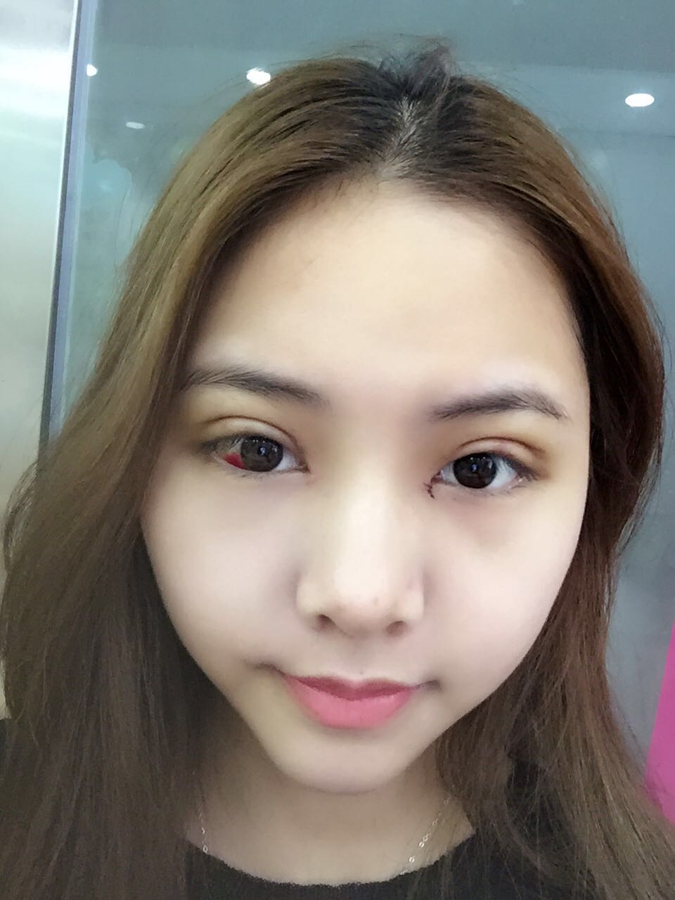 整形醫(yī)生徐長亮做切開雙眼皮案例效果對(duì)比圖
