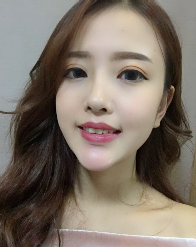 成都漢密爾頓美容醫(yī)院做牙齒矯正怎么樣？成都漢密爾頓牙齒矯正案例