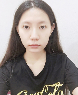  濟(jì)南安美醫(yī)療整形醫(yī)生李思思做下頜角整形怎么樣？李思思下頜角整形案例
