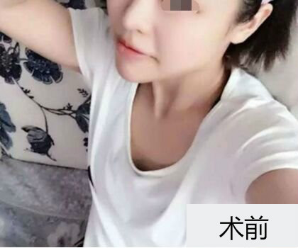 深圳博美整形醫(yī)生劉超做自體脂肪隆胸怎么樣？自體脂肪隆胸案例